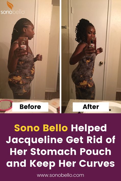 Sonobello Before And After Stomach, Sonobello Before And After, Sono Bello Before And After, Stomach Pouch, Beauty Maintenance, Becoming A Personal Trainer, Excess Skin, Good Birthday Presents, Vision Boards