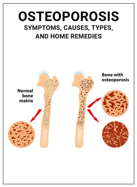 If you are looking for natural alternatives to treat osteoporosis or get some assistance, here is a list of some natural remedies just for you. Osteoporosis Symptoms, Dried Fig Recipes, Degenerative Disease, Natural Alternatives, Bone Diseases, Fig Recipes, Breast Health, Insulin Resistance, Cardiovascular Health