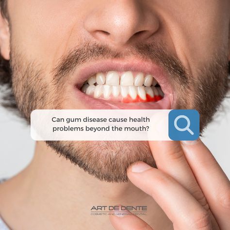 Gum Diseases Chart, Ways To Heal, Tired Of Waiting, How To Prevent Cavities, Melbourne Cbd, Periodontal Disease, Receding Gums, Healthy Teeth, Dental Implants