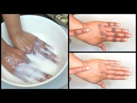 Dark Hands Remedies, How To Remove Dark Knuckles, Younger Looking Hands, Khichi Beauty, Knuckles Hand, Softer Hands, Dark Spots On Legs, Skin Lightening Diy, Dark Hands