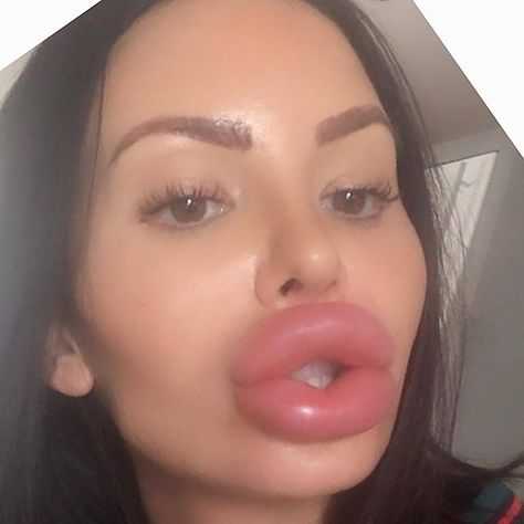 huge fake lips Big And Plump Lips, Big Plump Lips, Big Lip Subliminal, Big Round Lips Aesthetic, Big Lips Girl, Fake Lips, Lip Injections, Juicy Lips, Hot Lips