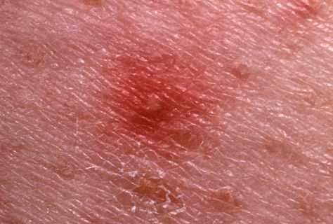 It might be tempting, but it’s best not to pick at these types of blemishes Red Spots On Legs, Red Spots On Face, Bumps On Legs, Bumps On Skin, Red Skin Spots, Spots On Legs, Skin Rashes, Skin Bumps, Keratosis Pilaris