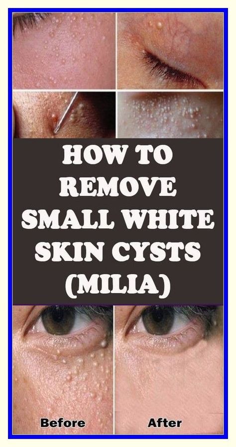 MILIA: HOW TO REMOVE THE SMALL WHITE SKIN CYSTS? White Bumps On Face, Bumps On Face, Milia Removal, Medical Terms, Natural Health Tips, Health And Fitness Tips, Health Facts, Alternative Medicine, Health And Wellbeing