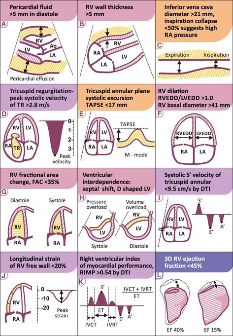 Echocardiography Cardiac Sonography, Pericardial Effusion, Sonography Student, Ultrasound Sonography, Diagnostic Medical Sonography, Ultrasound Technician, Ultrasound Tech, Cardiac Nursing, Medical School Studying