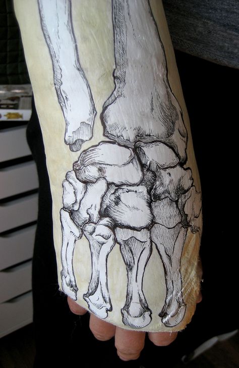 Bone Cast by Heather Tompkins at Coroflot.com Hand Plaster Fracture, Hand Plaster, Fun Anatomy, Anatomical Illustration, Her Drawing, Anatomical Art, Anatomy Images, Arm Cast, Cast Art