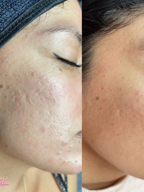 Before and After | Acne Free | Free The Pimple | Acne Positive | Acne Scars | Acne Acne Positive, Before And After Acne, Get Rid Of Pimples, Rid Of Pimples, How To Get Rid Of Pimples, Acne Solutions, Acne Free, Hair Stylist Life, Beauty Studio