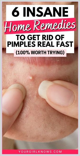 How to Get Rid of Pimples Overnight Acne Face Map, Get Rid Of Pimples Overnight, Rid Of Pimples Overnight, Face Map, Back Acne Remedies, Skin Care Hacks, Forehead Acne, Pimples Under The Skin, What Is Health