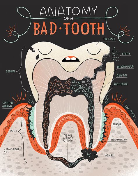 Inside a bad tooth by Rachel Ignotofsky www.rachelignotofskydesign.com Dental Assistant Study, Teeth Anatomy, Kedokteran Gigi, Dental Hygiene School, Teeth Art, Dental Anatomy, Dental Fun, Bad Teeth, Nice Teeth