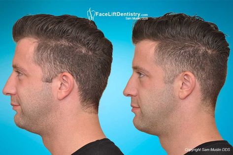 Natural overbite jaw correction with TMJ alignment to improve your profile and receding chin. No drill, braces, aligners, or surgery. Small Jawline, Weak Jawline, Receding Chin, Overbite Correction, Jawline Men, Weak Chin, Myofunctional Therapy, Orthodontics Braces, Healthy Teeth