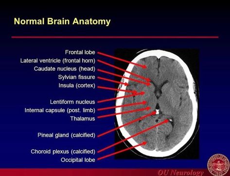 Brain Ct Anatomy, Ct Brain Anatomy, Studying For Ct Registry, Ct Scan Brain Anatomy, Ct Head Anatomy, Computed Tomography Study, Ct Scan Brain, Ct Anatomy, Ct Brain