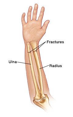 Radius And Ulna Anatomy, Ulna Anatomy, Anatomy Landmarks, Forearm Anatomy, Forearm Bones, Ulna Bone, Human Anatomy Picture, Radius Bone, Radius And Ulna