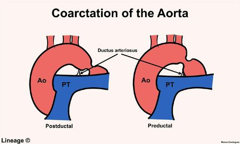 Coarctation Of The Aorta, Subclavian Artery, Nursing Positions, Sign Image, Nursing Study, Nursing Jobs, Cardiology, Jobs Hiring, To The