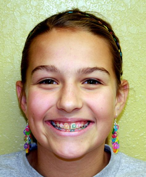 Clear Braces With Color Bands, Pink Braces, Ceramic Braces, Kids Braces, Braces Girls, Clear Braces, Braces Colors, Dental Braces, The Teeth