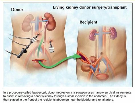 Living Kidney Donor Surgery/Transplant Kidney Transplantation, Kidney Surgery, Living Kidney Donor, Kidney Donation, Kidney Donor, Surgical Technologist, Donate Life, Organ Donor, Organ Donation