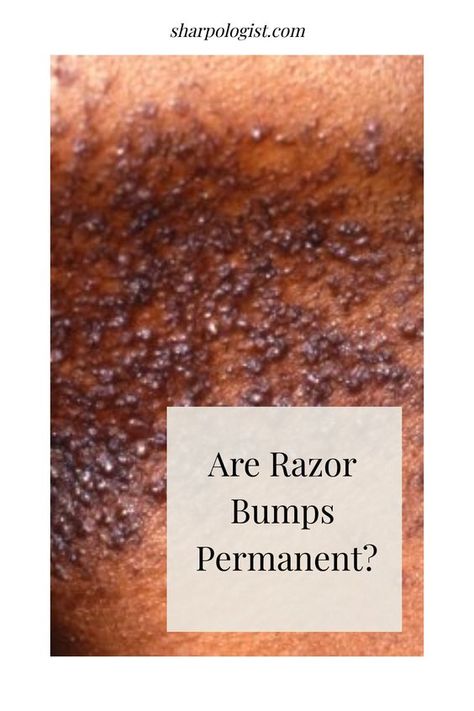 How to get rid of ingrown hairs, razor bumps, scars and dark spots EASY! How To Get Rid Of Razor Bumps, Razor Bumps Remedy, Get Rid Of Ingrown Hairs, Best Permanent Hair Removal, Razor Bump, Treat Ingrown Hair, Permanent Hair Removal Cream, Permanent Facial Hair Removal, Soothing Face Mask