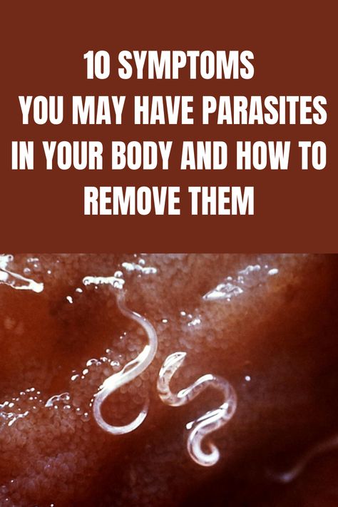 10 Symptoms You May Have Parasites in your Body (and how to remove them) Parasites Symptoms, Yoga Information, Natural Remedies For Migraines, Parasite Cleanse, Natural Health Tips, Natural Home Remedies, Health And Beauty Tips, Pregnancy Tips, Natural Living