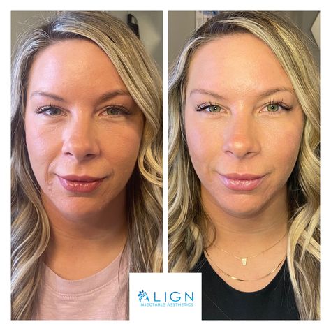 Smile Lines Filler Before And After, Smile Line Fillers Before And After, Smile Line Filler, Cheek Fillers, Nasolabial Folds, Smile Lines, Book Your Appointment, Plastic Surgery, Natural Beauty