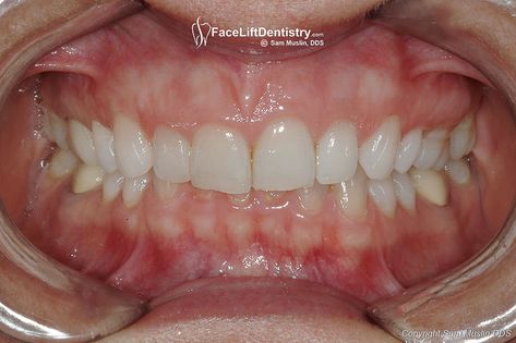 Correction wtihout usual with Deep Overbite Overbite Correction, Braces, Surgery