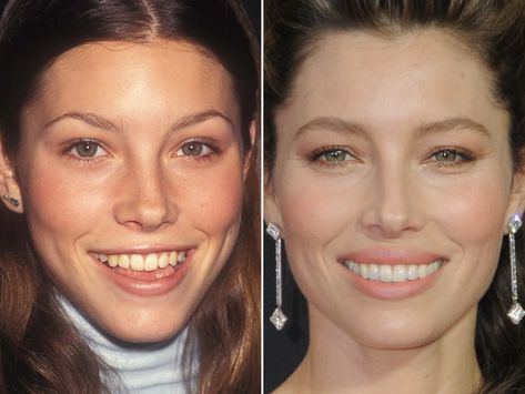 Jessica Biel Before and After - The Skincare Edit Underbite Before And After, Jessica Beil Hair, Plastic Surgery Before And After, Jessica Biel Hair, Jessica Biel Style, Cheek Implants, Plastic Surgery Gone Wrong, Botox Lips, Autumn Soft