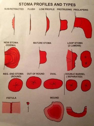 Picture Ostomy Nursing, Ostomy Life, Gi Issues, Medical School Interview, Wound Care Nursing, Ostomy Care, Midwifery Student, Nursing Assessment, Ostomy Bag