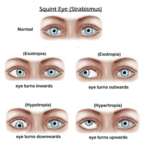 What is Strabismus (Squint)? Is a condition where the eyes do not look in the same direction. Whilst one eye looks forwards to focus on an object, the other eye turns either inwards, outwards, upwards or downwards. Most occur in childhood. The untreated affected eye can lead to visual loss called Amblyopia, by the child not using that eye to see. . #Eyehealth Strabismus Surgery, Eye Specialist, Lasik Eye Surgery, Eye Surgeon, Nursing Assessment, Laser Eye Surgery, Vision Therapy, Eye Exercises, Medical School Essentials