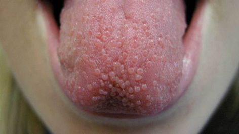 Tongue Bumps: Enlarged Papillae and Other Problems Tongue Sores Causes, Lie Bumps On Tongue, Bumps On Tongue, Canker Sore Causes, Tongue Sores, Asthma Inhaler, Body Diagram, Canker Sore, Tongue Health