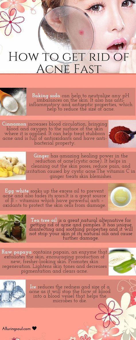 To avoid side effects of OTC medicines,there are powerful home remedies for how to get rid of acne and pimples fast as well as for removing acne black spot. Forehead Acne, Skin Moles, Acne Overnight, Skin Care Routine For 20s, Get Rid Of Acne, Get Rid Of Warts, Rid Of Acne, Natural Acne Remedies, Natural Acne