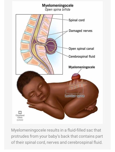 Myelomeningocele is a type of spina bifida — a birth defect in which your baby’s spine and spinal canal don’t close before birth. Healthcare providers can usually diagnose myelomeningocele during pregnancy and perform surgery during pregnancy or after birth to repair the opening in your baby’s spine. #spinabifidastrong #spinabifidawarrior #spinabifida #spinabifidaawareness #parenting #charity Pediatric Nursing Study, Obstetrics Nursing, Spina Bifida Awareness, Midwifery Student, Weeks Of Pregnancy, Medical Ultrasound, Spinal Fluid, Spina Bifida, Nursing School Humor