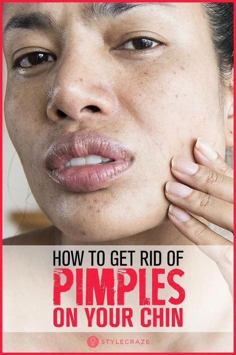 Flat Warts, Warts On Hands, Chin Acne, Warts On Face, Get Rid Of Pimples, Rid Of Pimples, Pimples Remedies, Skin Growths, Get Rid Of Warts