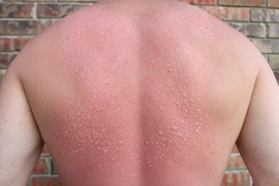 Serious Sunburns | University of Utah Health Sun Blisters, Sun Poisoning, Sunburn Blisters, Get Rid Of Sunburn, Severe Sunburn, How To Treat Sunburn, Types Of Rashes, Bad Sunburn, Sunburn Remedies