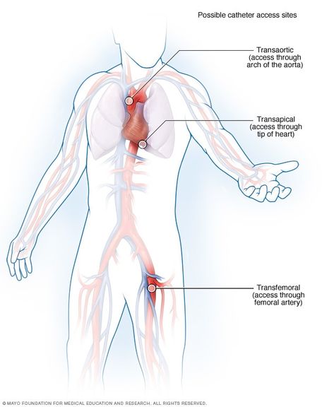 Transcatheter aortic valve replacement (TAVR) - Mayo Clinic Aortic Valve Replacement, Medical Device Design, Heart Valves, Acute Care, Heart Surgery, Medical Art, Mayo Clinic, Heart Healthy, Health And Wellbeing