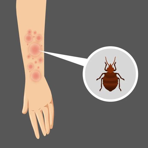 #BedBugBites #Bedbugbitesonspiders #Detected #SpiderPopulations #UnravelingtheMystery Bed Bug Bites Pictures, Signs Of Bed Bugs, Spider Species, Bed Bug Bites, Household Pests, Bug Control, Bed Bug, Second Hand Furniture, Mosquito Bite