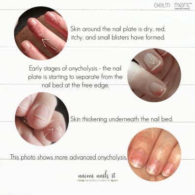 nails, nail polish, nail allergy, gel polish allergy, allergic reaction, naomi nails it Nail Damage From Gel, Gel Nail Allergy, Nail Allergies, Nail Facts, Gel Moment, Gel Nail Light, Gel Polish Brands, Nail Infection, Skin Gel