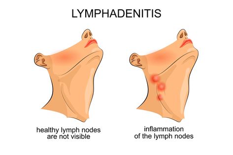 Essential Oils For Lymph Nodes – Time To Deflate Those Painful Mini-Beans Essential Oil Benefits Oils For Lymph Nodes, Essential Oils For Lymph Nodes, Essential Oil For Swelling, Lymph Glands, Natural Decongestant, Lung Infection, Lymph Fluid, Lymph System, Essential Oils For Pain