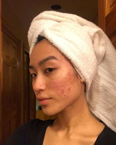 Girl With Acne, Lemon Face Mask, Pele Natural, How To Get Rid Of Pimples, Normal Body, Bare Beauty, Love Your Skin, Pretty Skin, Raw Beauty