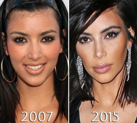 Never get tired of the maintenance! Kardashians Before And After, Flat Cheeks, Kardashian Plastic Surgery, Kim Kardashian Nails, Young Kim Kardashian, Kim Kardashian Before, Cheek Implants, Kim Kardashian Wedding, Nose Jobs