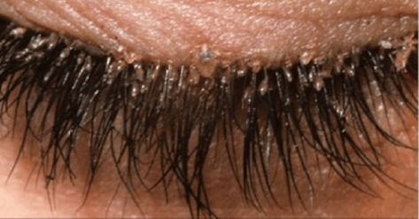 What Are Eyelash Mites? Woman Suffers Redness In Eyes Due To Parasites Eye Mites, Mites On Humans, Demodex Mites, Eyelash Extentions, Stimulate Hair Growth, Hair Follicle, Lavender Essential Oil, Skin Care Regimen, Dead Skin