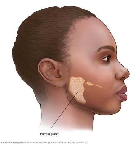 Parotid tumors - Overview Salivary Glands, Parotid Gland, White Tongue, Salivary Gland, Sjogrens Syndrome, Facial Nerve, Dry Mouth, Autoimmune Disorder, Mayo Clinic