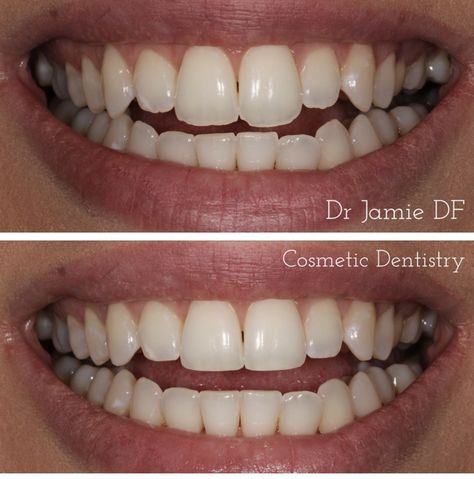 Teeth Reshaping (Enameloplasty) - Harley Street Smile Clinic Teeth Reshaping Before And After, Canine Tooth, Cosmetic Treatments, First Tooth, Cosmetic Dentistry, Your Smile, Pain Free, Quick Saves