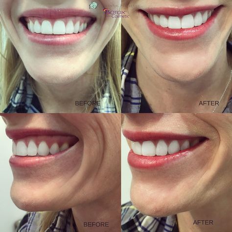 Gummy Smile Correction, Botox Cosmetic, Gummy Smile, Physician Assistant, Inspiration Board, Smile Face, Braces, Vision Board, Facial