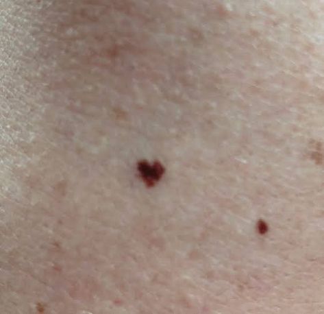 Cute Birthmarks Aesthetic, Birthmarks For Shifting, Body Moles Aesthetic, Birthmarks Aesthetic, Heart Freckle Tattoo, Freckle Tattoo, Mole Tattoo, Traditional Tattoo Sleeve, Best Horror Movies