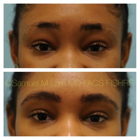 This 26-year-old African-American woman had her eyebrows tattooed but they ended up higher than she wanted and had them removed and is shown before and after eyebrow hair transplant. Eyebrows Black Women, Eyebrow Hair Transplant, Tattoo Eyebrows, Ethnic Hair, Tattoo Cream, Ethnic Hairstyles, Eyebrow Tattoo, American Woman, Tattoo Removal