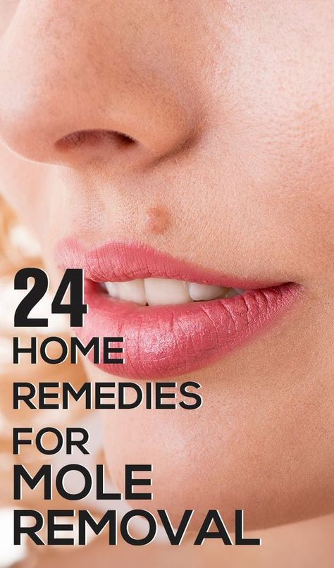 Is your beauty being destroyed because of moles? Mole removal may be quite painful,follow these effective home remedies for mole removal which are safe & easy. Cancerous Moles, What Causes Warts, Dark Mole, Warts On Hands, Warts On Face, Skin Moles, Skin Growths, Mole Removal, Get Rid Of Warts