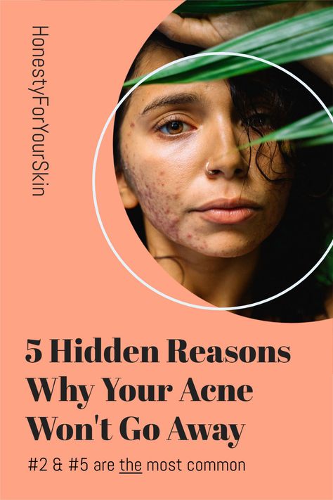 Acne Reasons, Back Acne Remedies, Blind Pimple, Acne Diet, Pimples Under The Skin, Acne Overnight, Prevent Pimples, Natural Acne Remedies, How To Get Rid Of Pimples