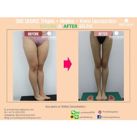 Leg Lipo Before And After, Wl Before And After, Legs Before And After, Thigh Lift Before And After, Liposculpture Before And After, Lipo 360 Before And After, Before And After, Body Sculpting Surgery, Leg Surgery