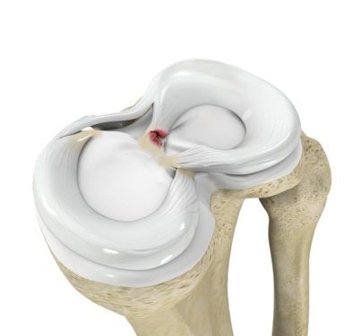 Meniscal root tears are devastating tears of the meniscal cartilage in the knee at the point where it connects to bone. In essence, the root is the anchor point of the meniscus. Such tears can lead to significant knee pain, dysfunction, instability and rapid development of osteoarthritis. Meniscus Surgery, Dupuytren's Contracture, Meniscal Tear, Knee Strength, Acl Tear, Knee Replacement, The Anchor, Knee Pain, The Knee