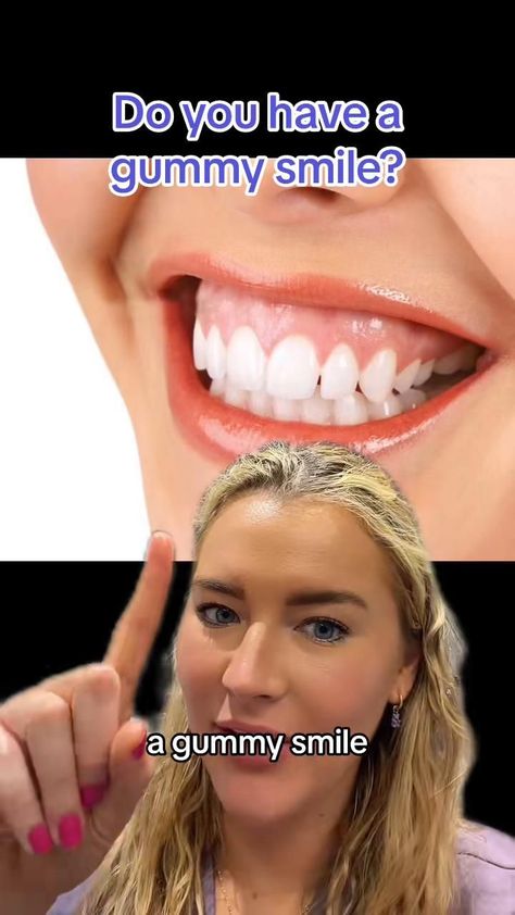 4 ways to fix gummy smile featuring 1 Perfect Teeth Smile, Gummy Smile Correction, Dentist Career, V34 Colour Corrector, Lip Flip, Botox Before And After, Quick Yoga, Colour Corrector, Whitening Teeth