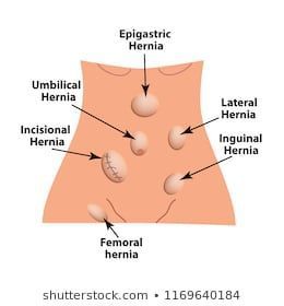 Here we discuss types of hernia. if you feel any kind of symptoms regarding Hernia please contact Dr. Sarfaraz J Baig Surgical Technologist, Homeopathy Medicine, General Surgery, Homeopathic Medicine, Alternative Treatments, Medical Education, Abdominal Muscles, Success Rate, Homeopathy