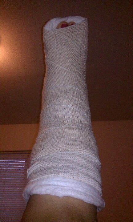 Day 4 (Sunday), still in my ankle splint with ace bandage.  Had to up the Percoset dose...2 every 4 hours now.  Go away pain!!! Leg Bandage Snapchat, Ace Bandage, Hospital Admit, Hospital Admit Hand Pics, Broken Ankle, Leg Injury, Broken Arm, Hospital Photos, 4 Hours