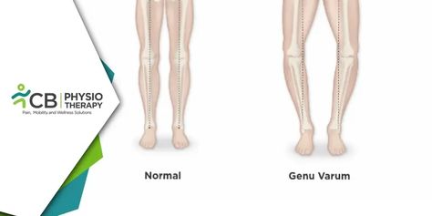 Managing Genu Varum in Kids with Physiotherapy Physio Tips, Genu Varum, Rehabilitation Exercises, Bow Legged, Child Health, Childrens Health, Free Life, Better Health, Health Blog